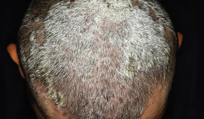 Plaque Psoriasis on Scalp at baseline vs. by week 24 of SOTYKTU® treatment