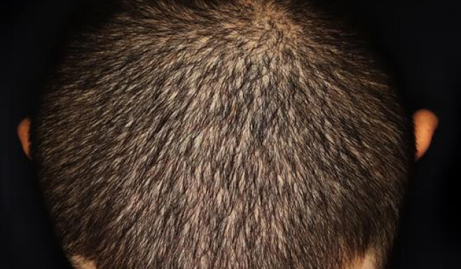 Plaque Psoriasis on Scalp at baseline vs. by week 24 of SOTYKTU® treatment